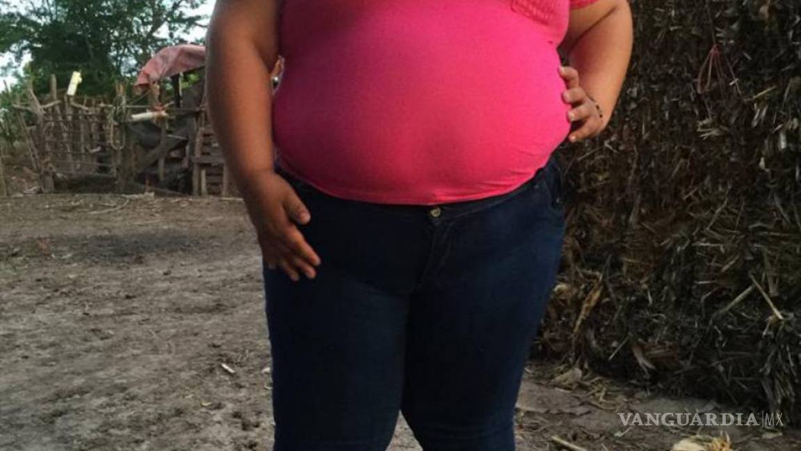 Dayana, 14 años, 195 kilos y un by-pass gástrico para mejorar su vida