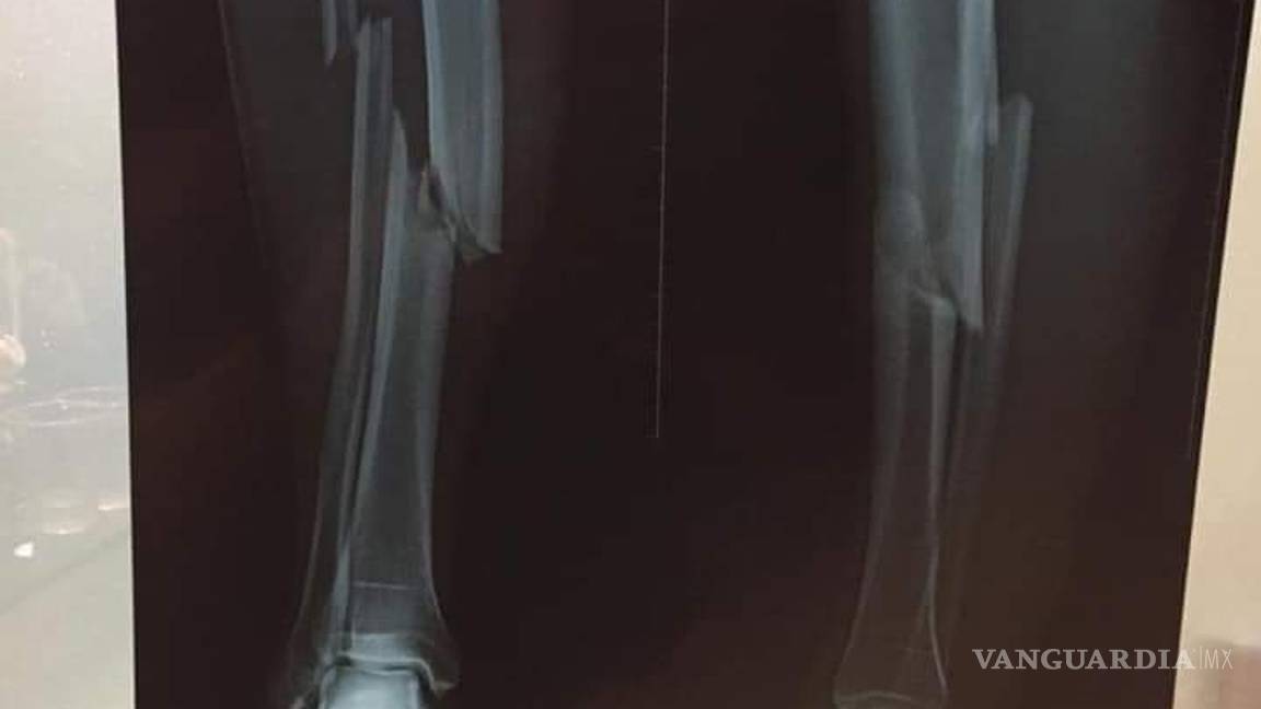 $!La fatal lesión que sufrió un jugador de la Liga de Bolivia tras una 'criminal' entrada