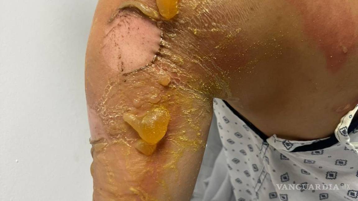 $!A través de redes sociales, se compartieron imágenes de asistentes que sufrieron quemaduras y lesiones.