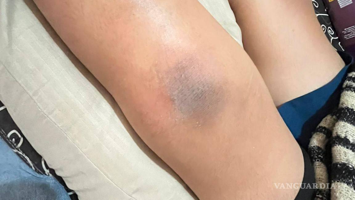 $!La cirugía del estudiante implicó la colocación de tornillos en la tibia, costos que inicialmente cubrieron los tutores.