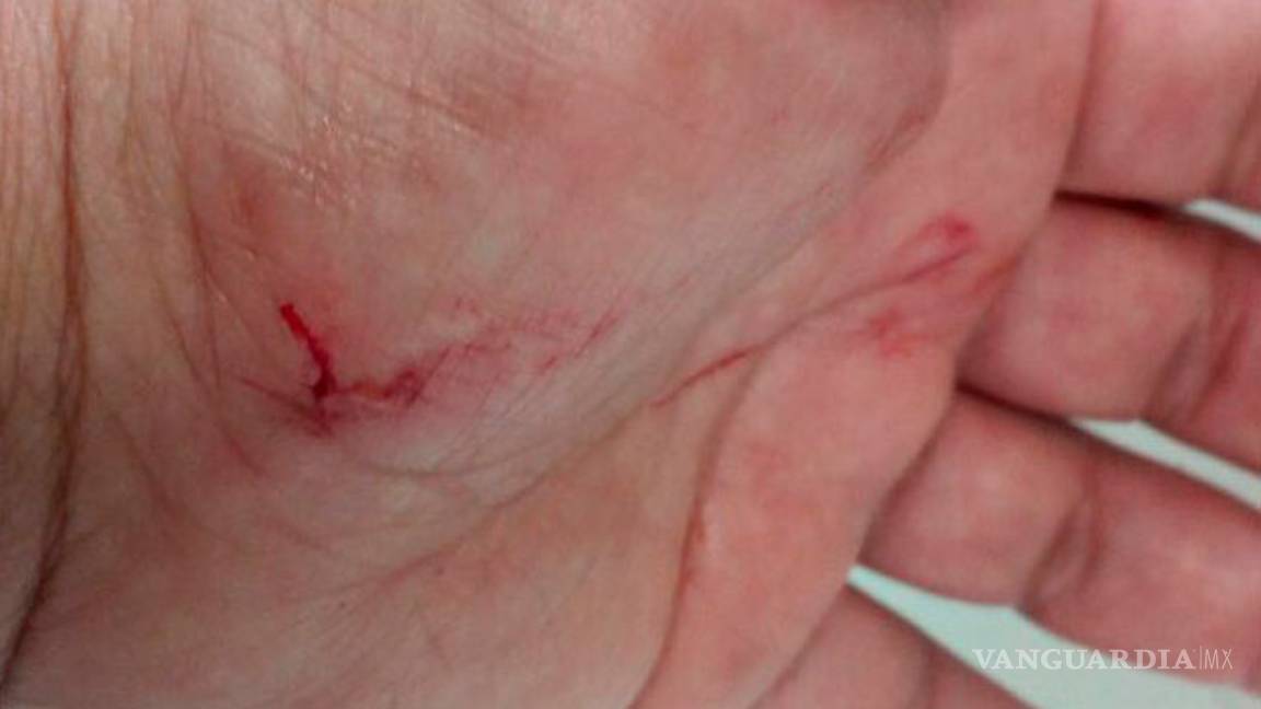 $!En Parras, mujer sufre ataque de perro pitbull