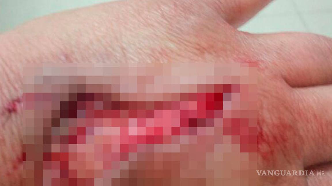 $!En Parras, mujer sufre ataque de perro pitbull