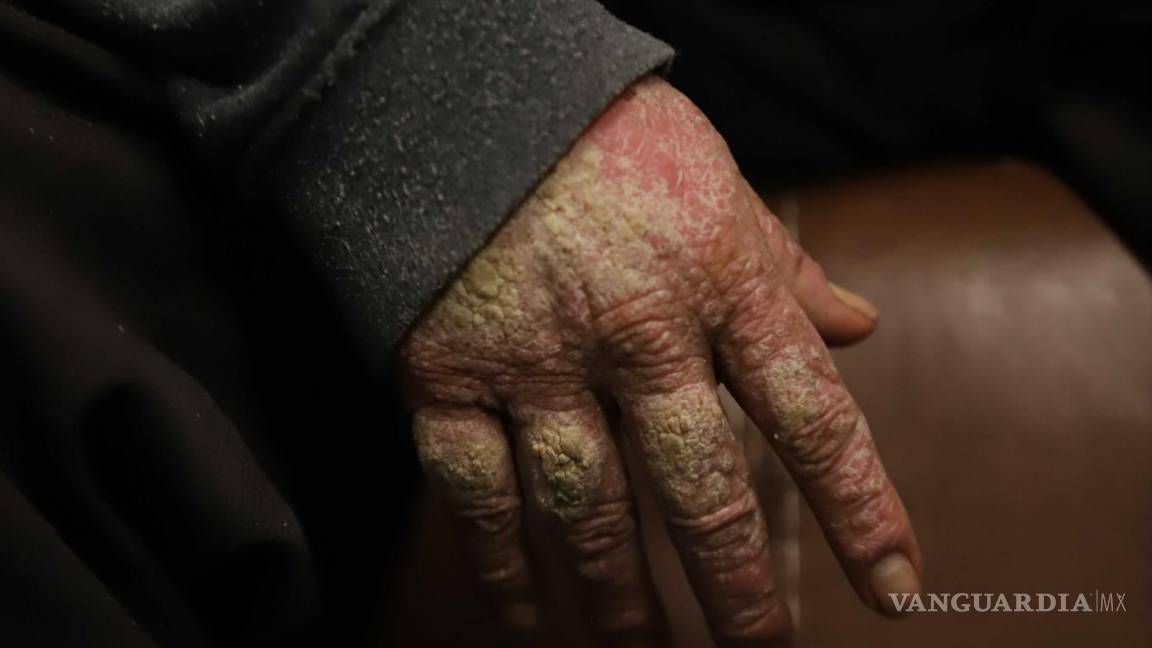 $!La psoriasis artrítica de Regino le provoca llagas y malformaciones óseas, haciendo que cada día sea un desafío debido al dolor constante.