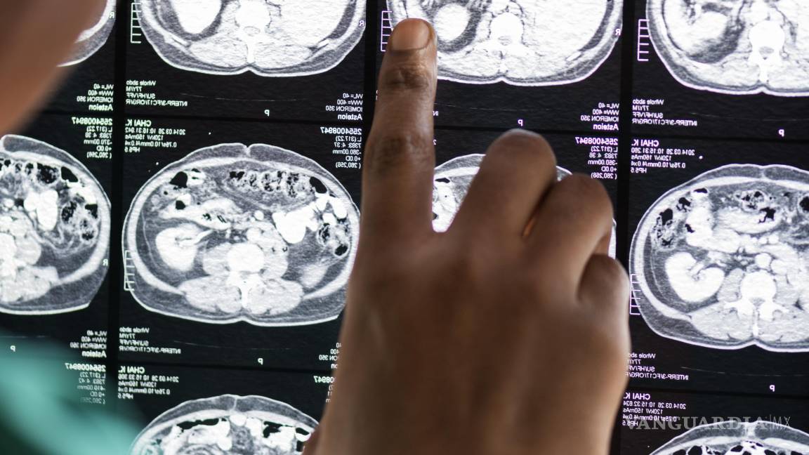 $!Existen dos tipos principales de ictus: el ictus isquémico, al que corresponden casi el 80% de los casos.