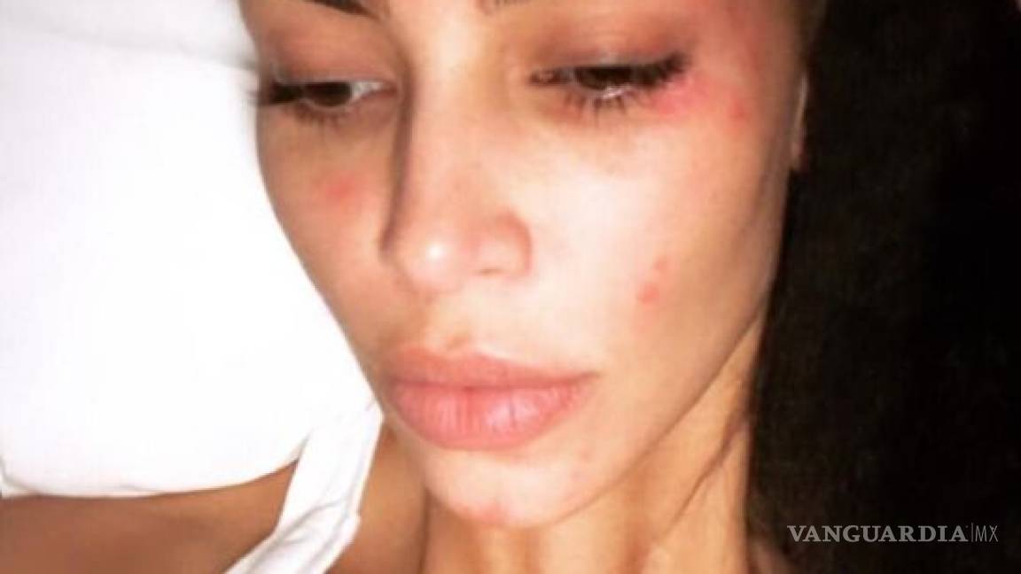 Kim Kardashian comparte foto de su enfermedad crónica