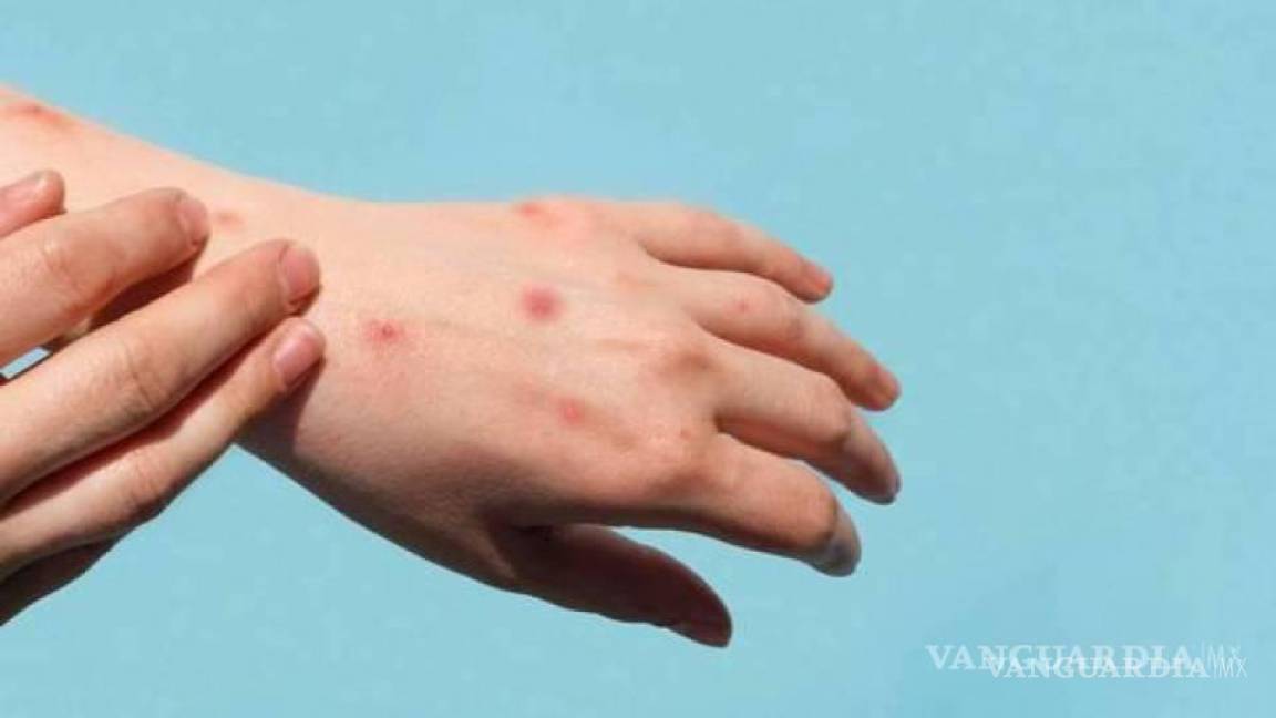 OMS estima que viruela símica se ha reducido a un 90% a nivel mundial