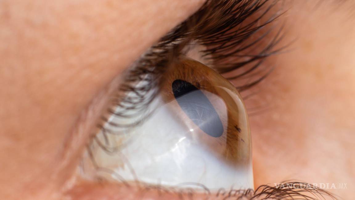 El queratocono, una enfermedad ocular poco conocida, pero frecuente en adolescentes y jóvenes