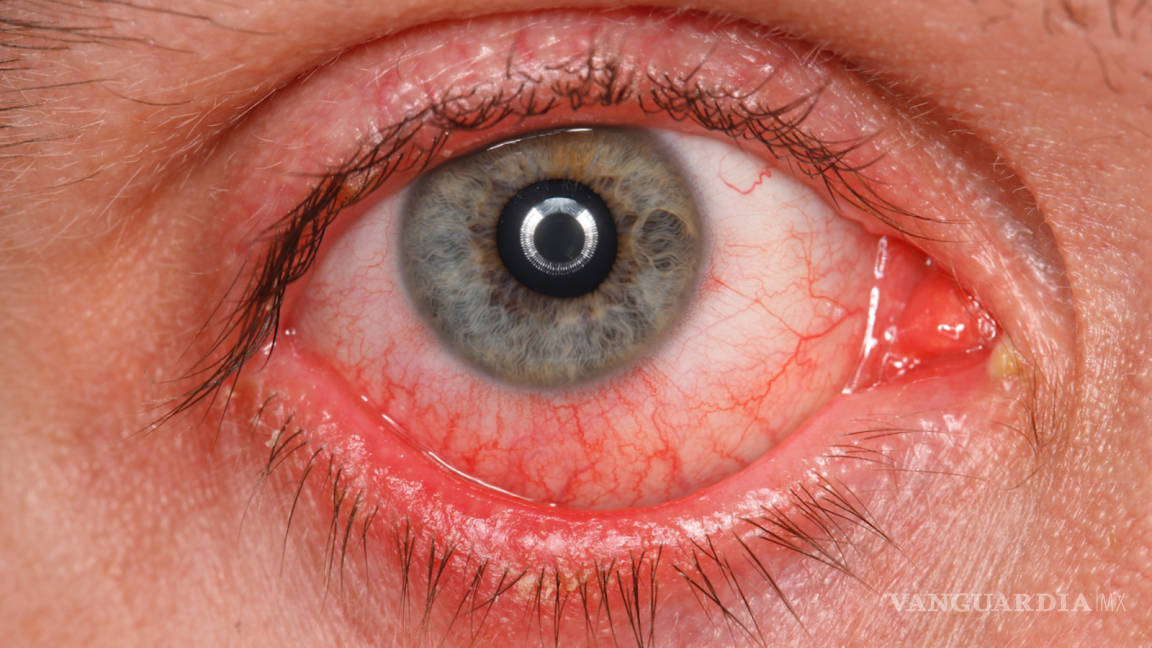 Ojos de pacientes con casos graves de COVID-19 presentan anomalías