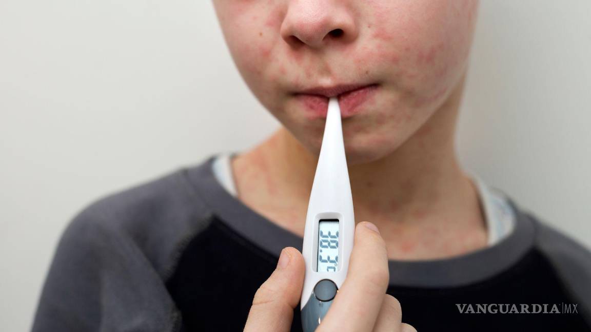 Sarampión: Cuánto tarda en manifestarse la enfermedad tras el contagio