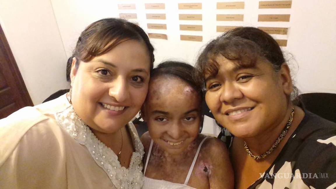 Piden apoyo para Alma, joven de Monclova que padece 'piel de mariposa'
