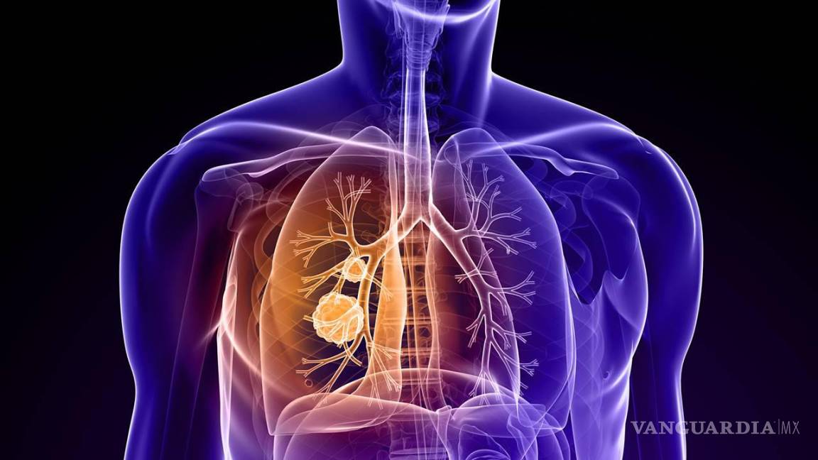 Detectan al mes 16 casos de cáncer de pulmón en Región Sureste de Coahuila