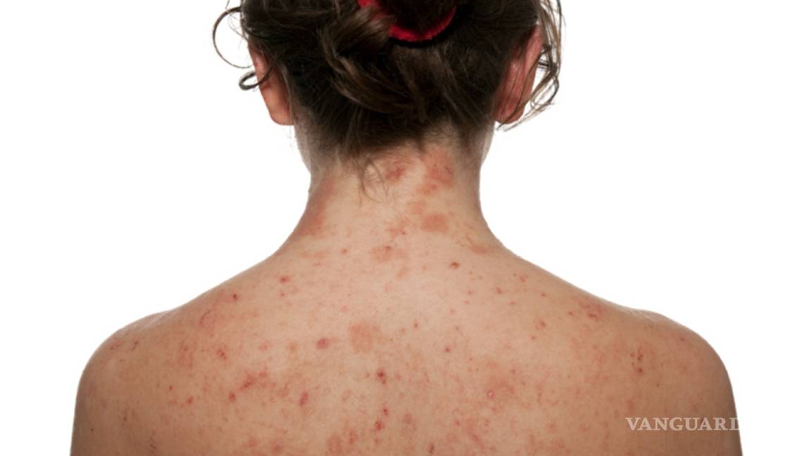 7+ consejos para controlar la dermatitis o eccema