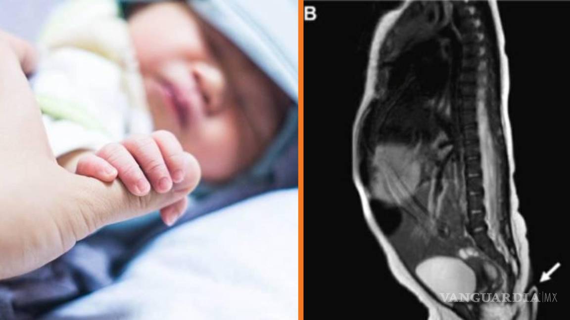 Nace en Nuevo León bebé con cola de 5.7 centímetros de largo, documenta revista médica
