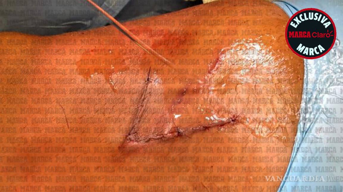 $!Estas son las imágenes de la operación de Giovani dos Santos (se recomienda discreción)