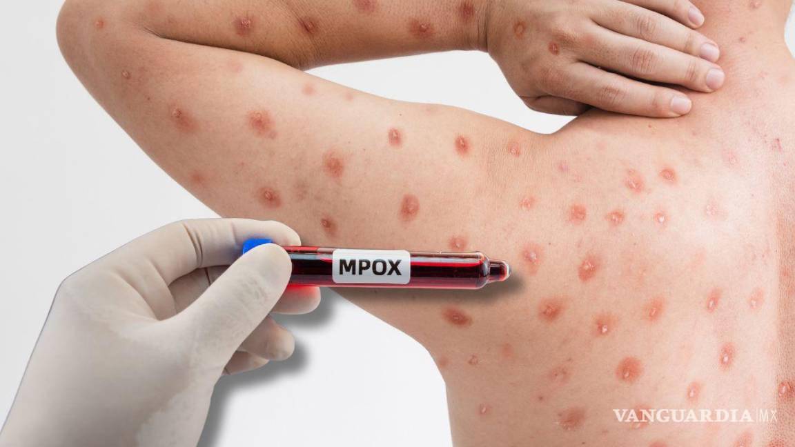 Surgen nuevos casos de Mpox en municipios de Baja California Sur; suman 5 en dos meses