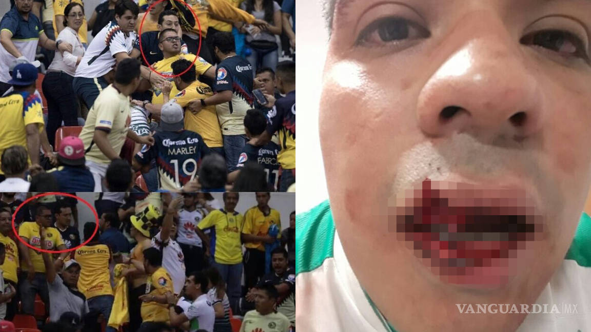 Aficionado del Santos requirió de una cirugía reconstructiva en el rostro tras la brutal golpiza que recibió de inadaptados americanistas