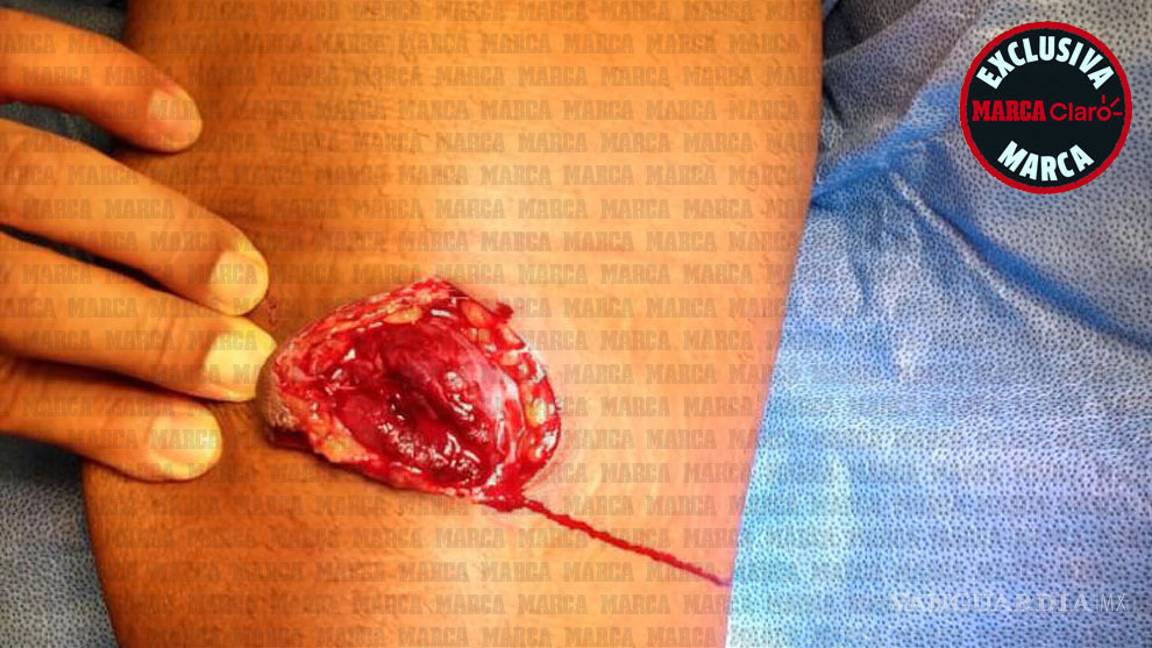 $!Estas son las imágenes de la operación de Giovani dos Santos (se recomienda discreción)