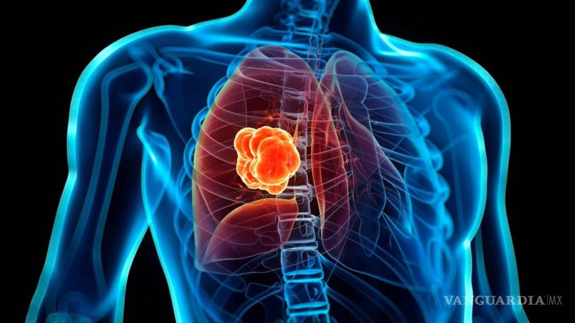 Tratamiento con inmunoterapia aumenta la supervivencia en cáncer de pulmón