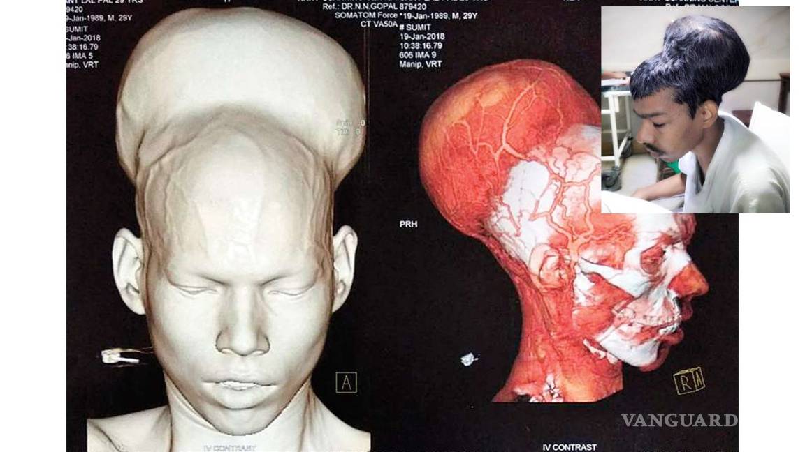 Cirujanos de la India extirpan un tumor cerebral de 1.87 kilos, el más grande del mundo