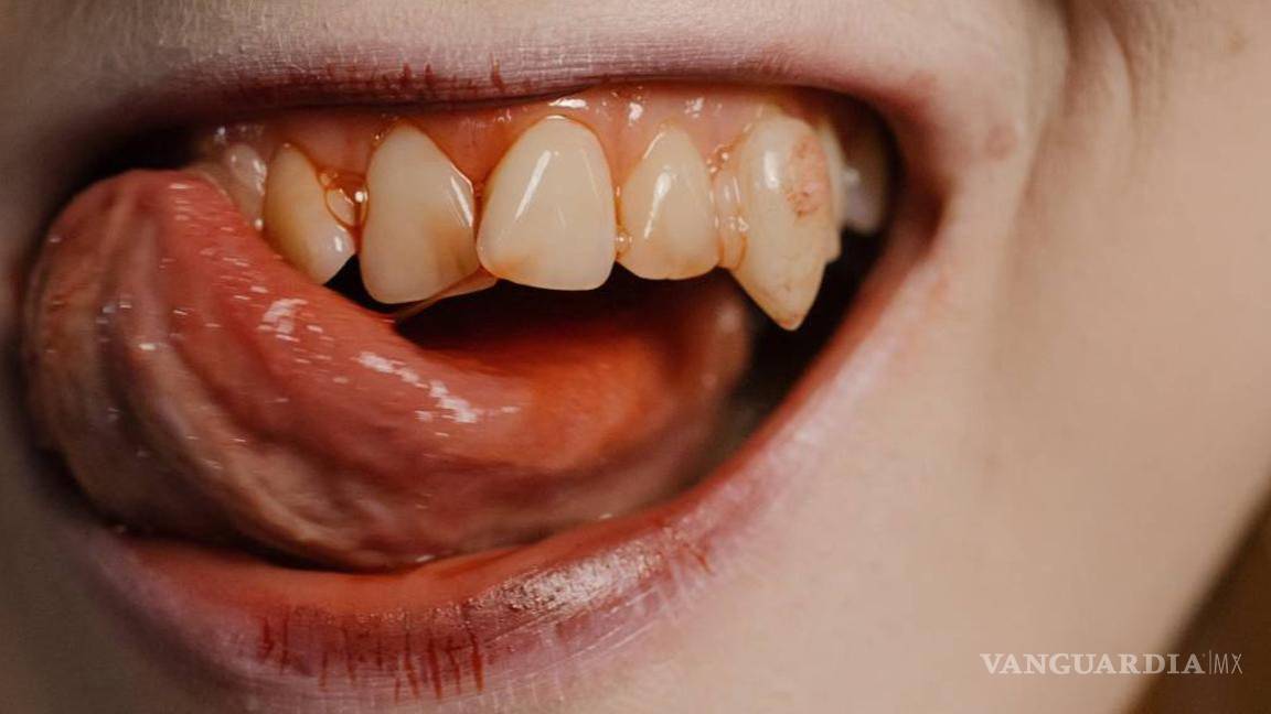 ¿Qué es la porfiria?... la enfermedad incurable ligada a los Vampiros; aquí sus síntomas