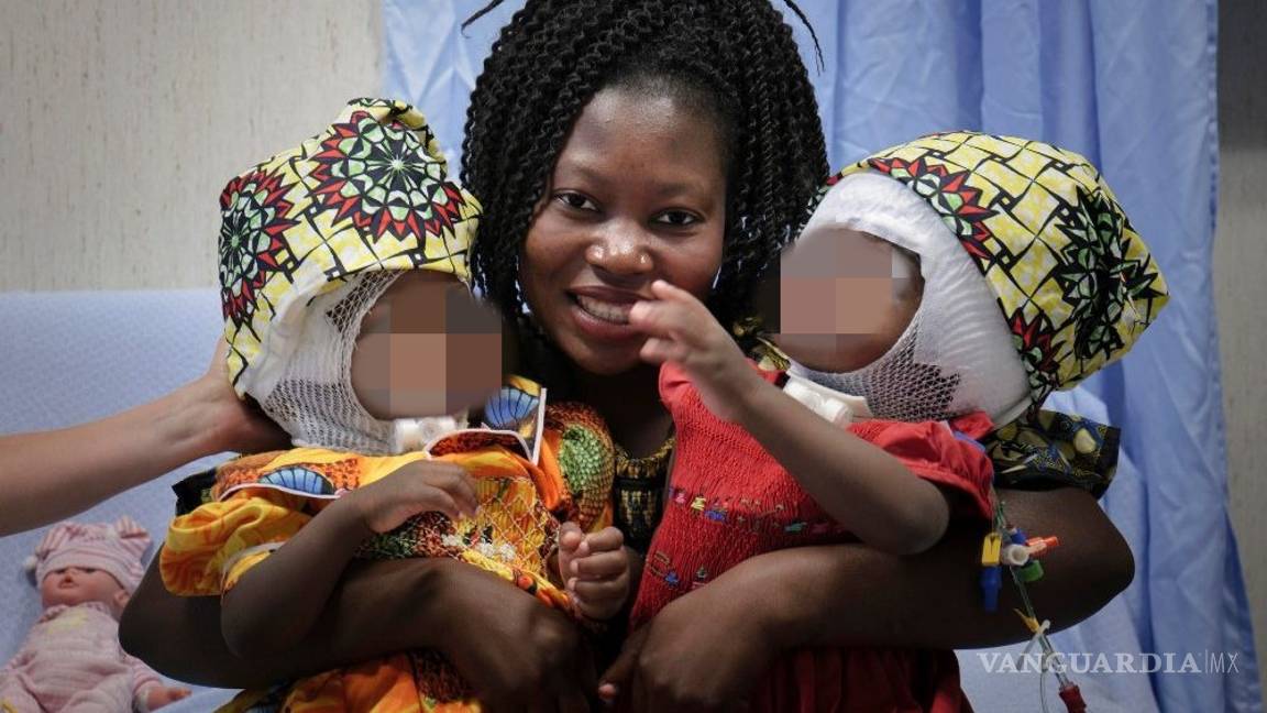 $!Papa Francisco bautiza a las niñas siamesas unidas por la cabeza que fueron operadas en Roma