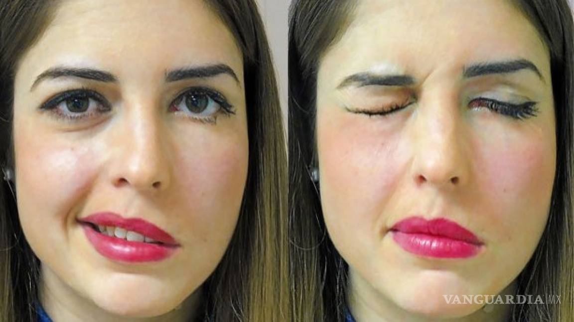 Atención, estas son las cinco causas que producen una parálisis facial