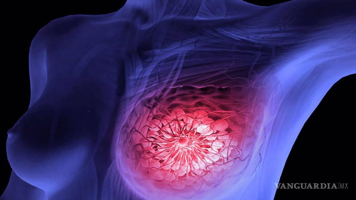 70% de mujeres con cáncer de mama pueden evitar 'quimio'