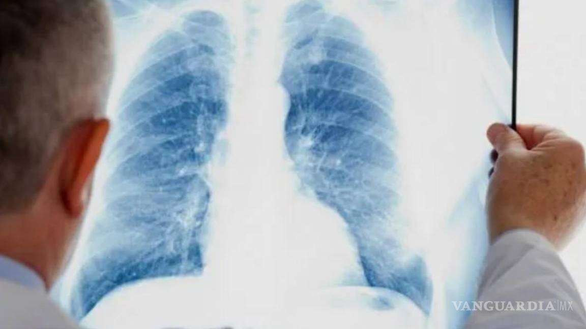 Registra México más de 7 mil casos de cáncer de pulmón por año