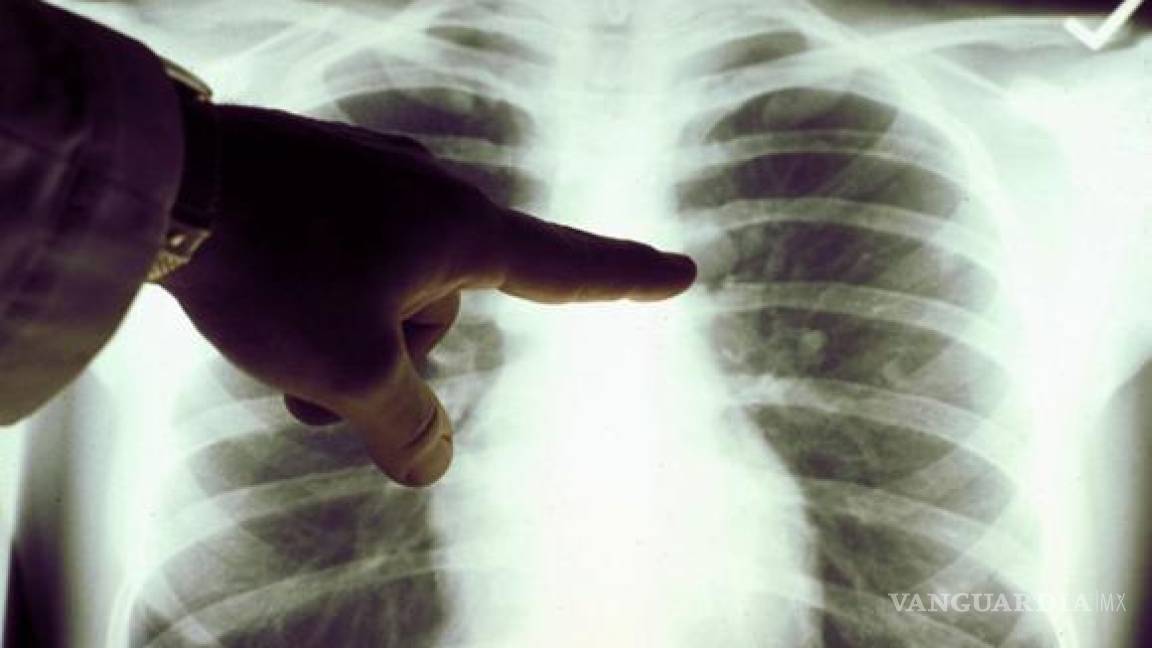 Saltillo: atención pulmonar a pacientes post COVID-19