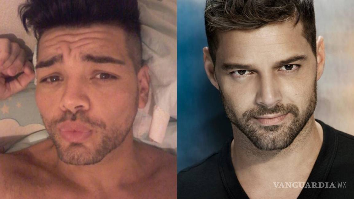 Se opera 27 veces para parecerse a Ricky Martin y así luce ahora