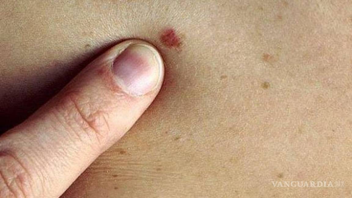 $!¡Cuidado con el cáncer de piel! ¿Te estás protegiendo?