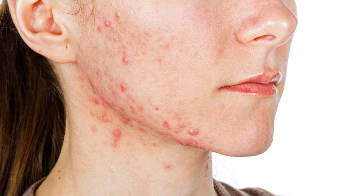 $!Una de las mejores recomendaciones dermatológicas es el jabón con peróxido de benzoilo.