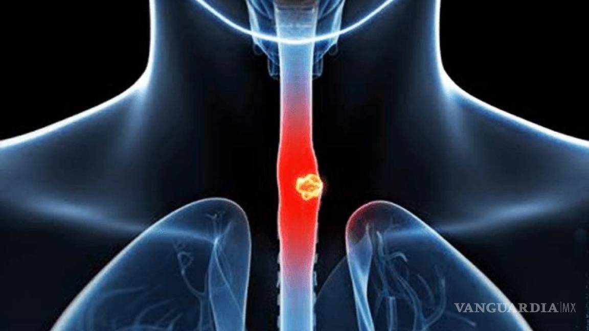 7 señales del cáncer de esófago