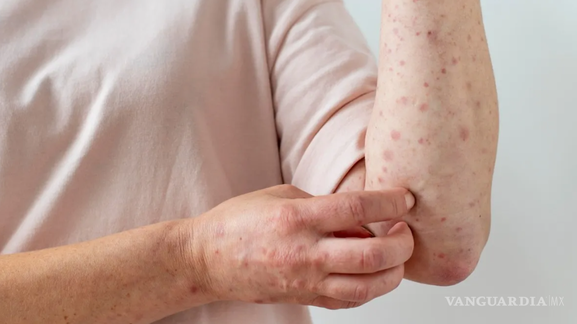 $!Quizá parezca contradictorio, pero la sequedad puede irritar la piel y empeorar el acné.