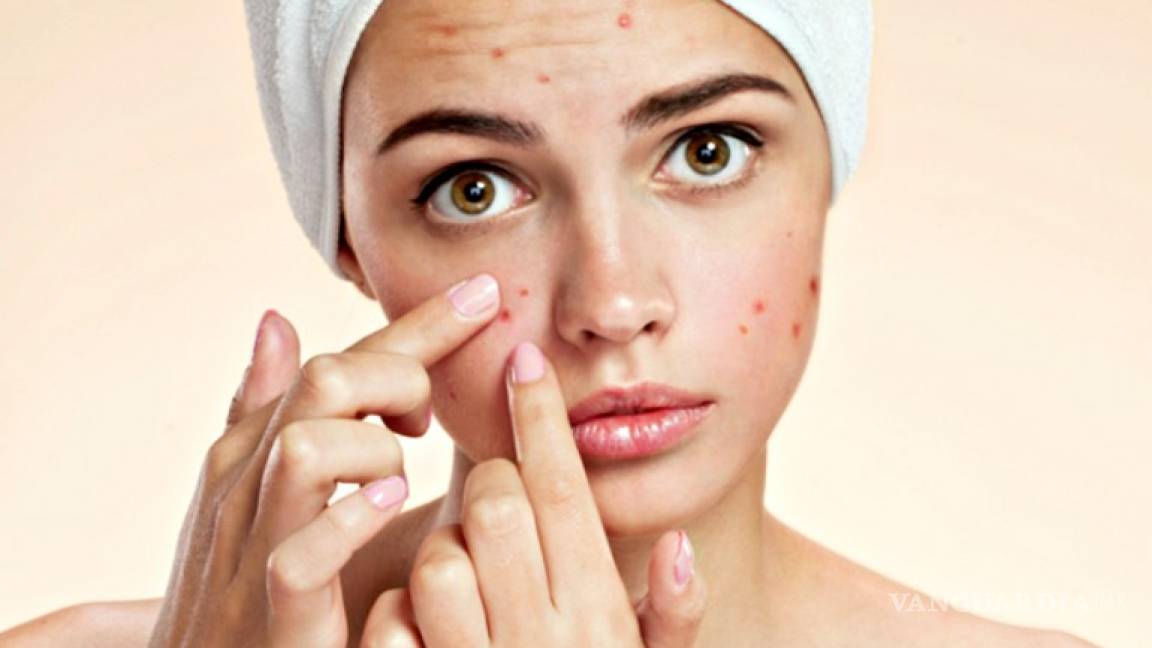 4 aspectos positivos del acné