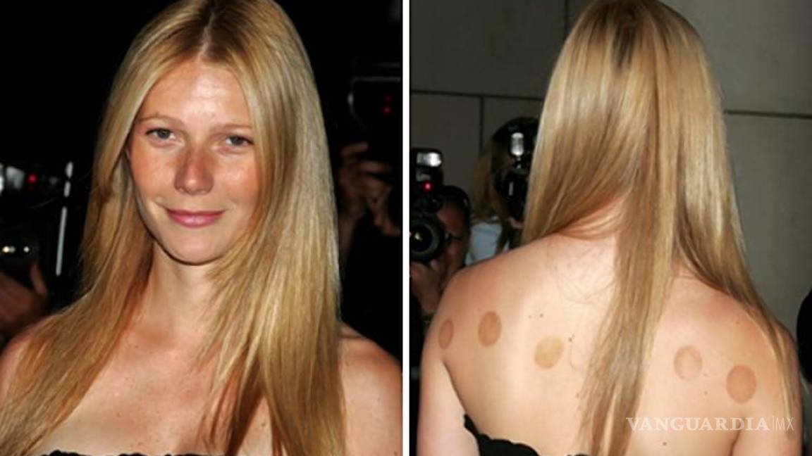 $!Te explicamos la razón de las extrañas marcas que tiene Michael Phelps en su cuerpo