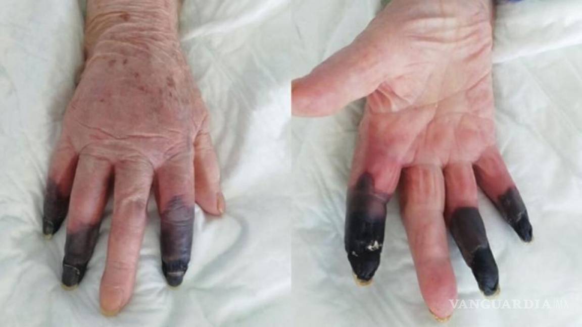 Mujer se contagió de COVID-19 y le provocó gangrena; sufrió amputación de dedos