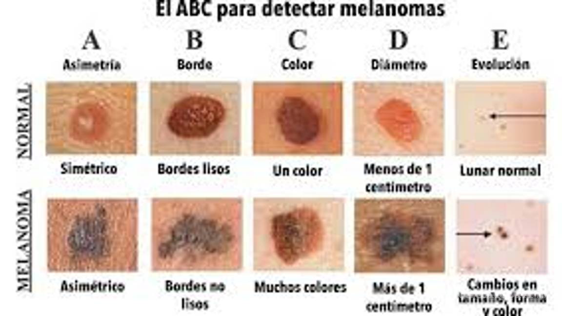 $!¡Cuidado con el cáncer de piel! ¿Te estás protegiendo?