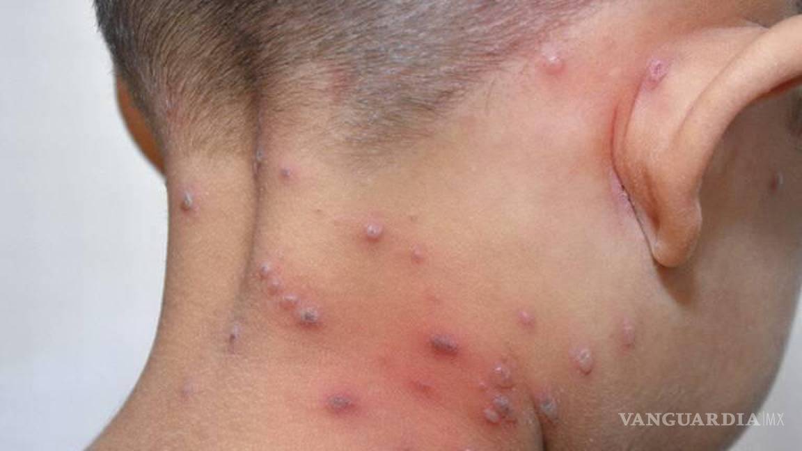 $!La varicela puede resultar contagiosa para aquellas personas que no hayan sufrido la enfermedad o que no se hayan vacunado. El síntoma más característico es un sarpullido con picazón similar a una ampolla en la piel.