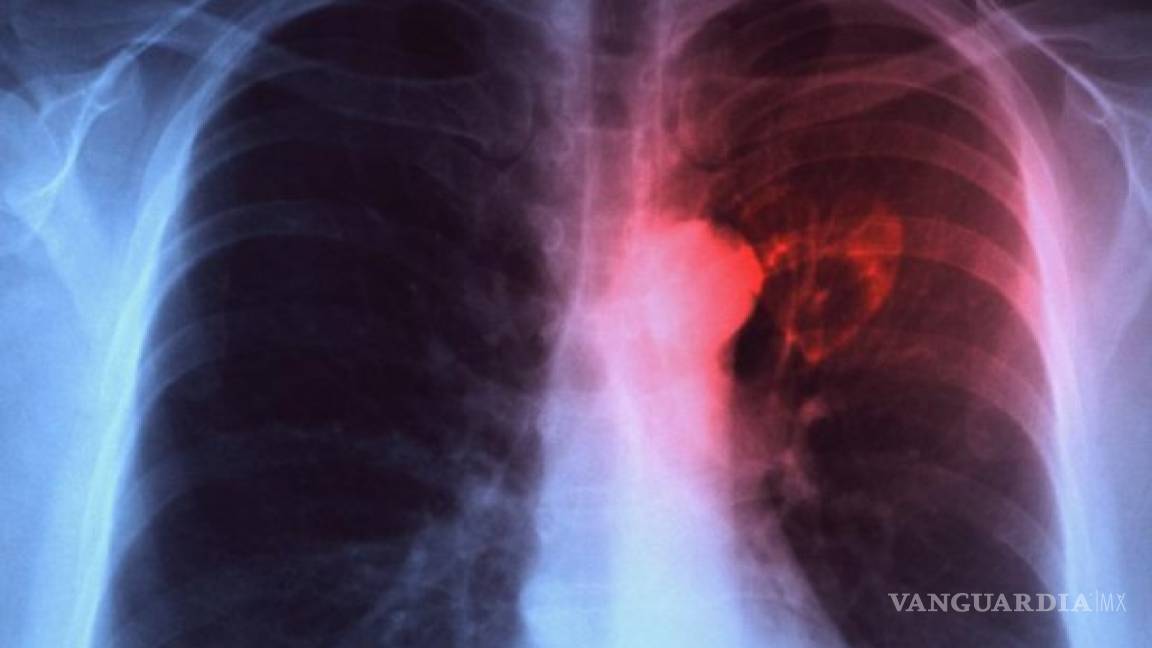 Tuberculosis provoca tantas muertes a nivel mundial como el Sida, alerta la OMS