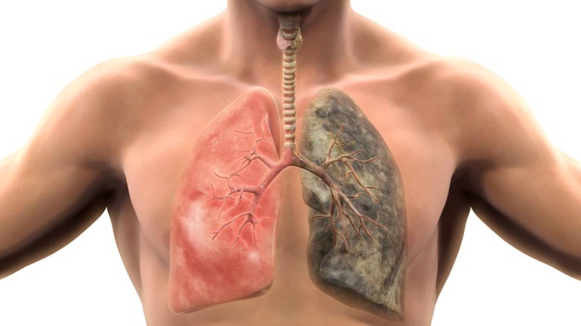 Cáncer de pulmón cobra cuatro vidas cada semana en Coahuila