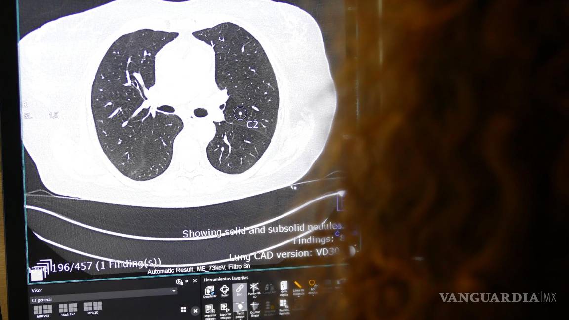 $!Imagen de una tomografía computarizada pulmonar en la que la IA muestra la presencia de un nódulo pulmonar sospechoso.