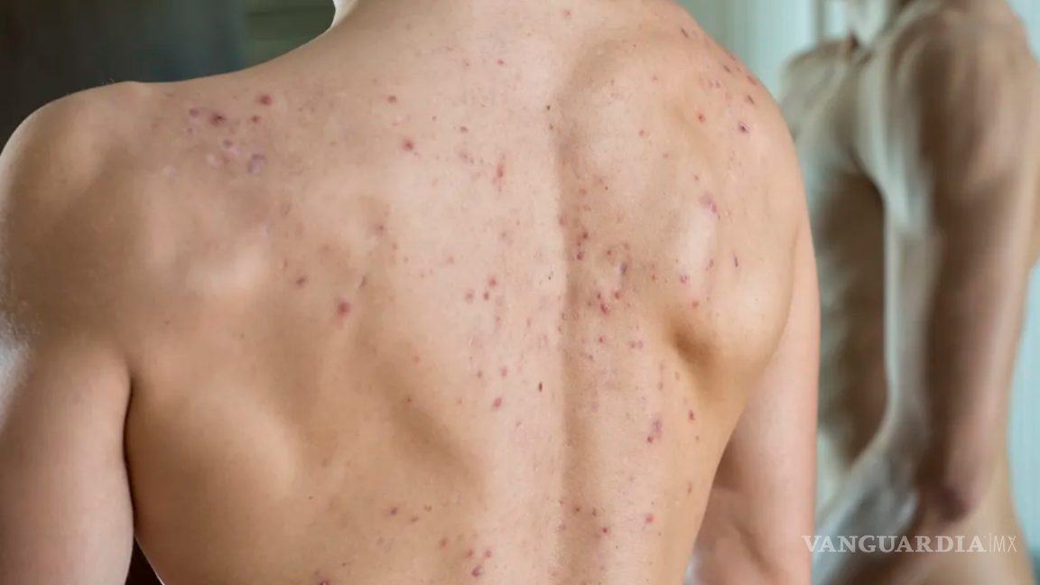 $!El adapaleno mejora la apariencia de la piel y evita la acumulación de células muertas.