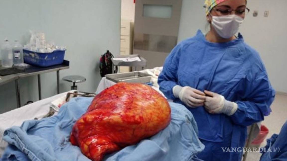 Extirpan tumor abdominal de 17 kilos a una mujer en un IMSS