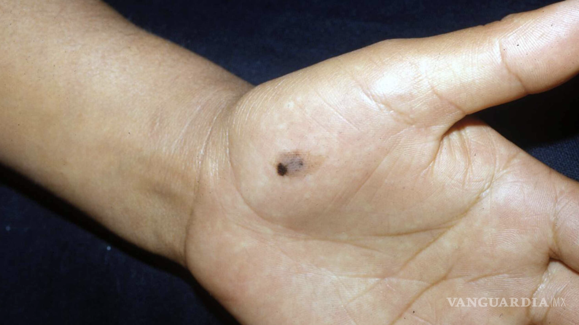 $!El melanoma acral es un tipo de cáncer de piel que aparece como una mancha irregular y oscura.