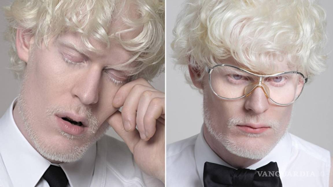 Top Models: Los albinos están de moda