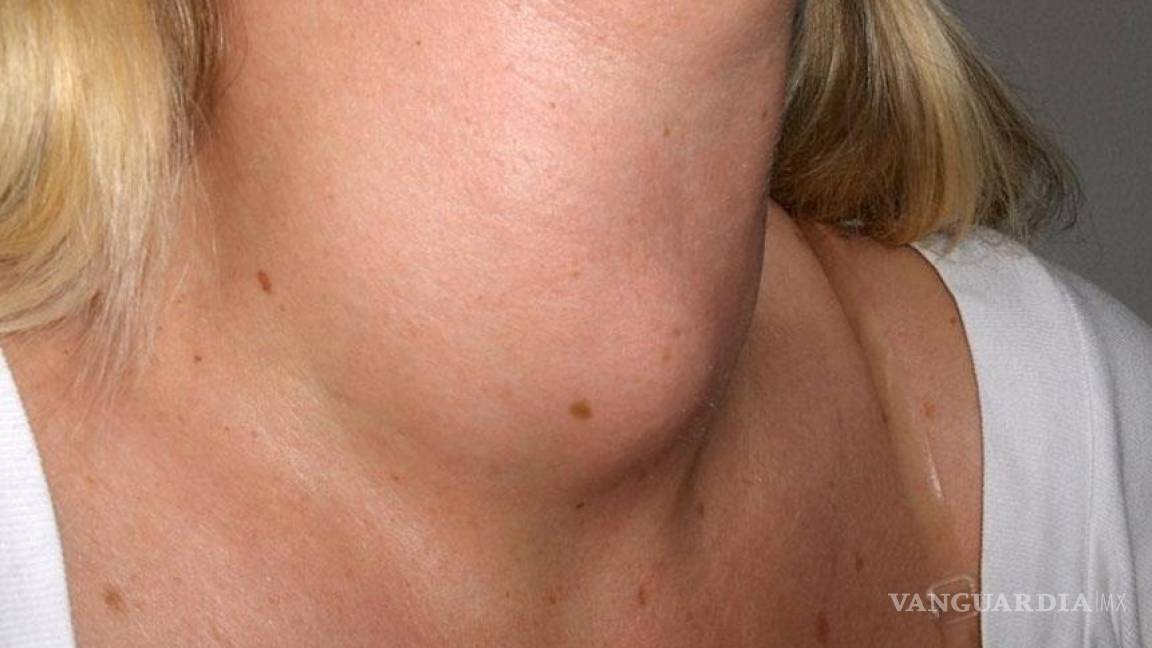 ¿Qué es un nódulo tiroideo?