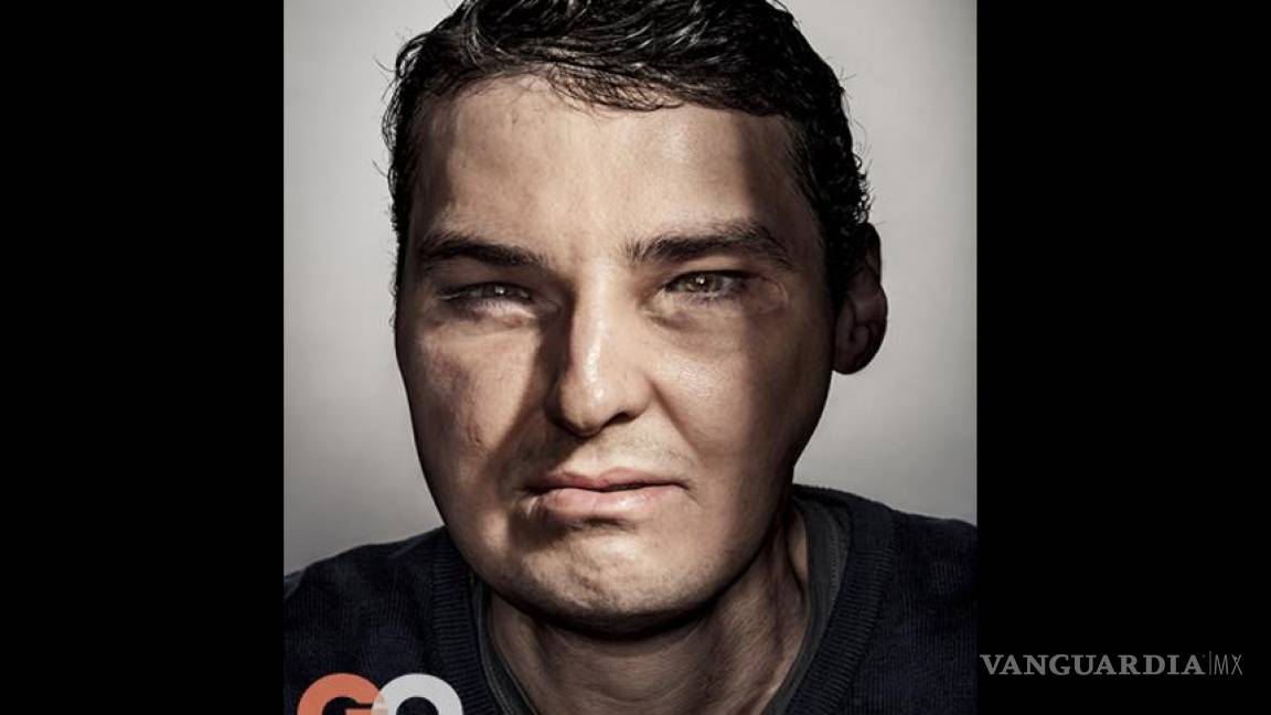 Hombre que recibió trasplante de rostro posa para GQ