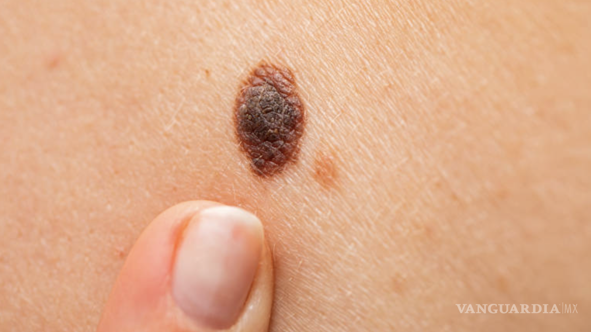 $!En México, el melanoma acral representa alrededor del 50% de los casos de melanoma diagnosticados cada año.