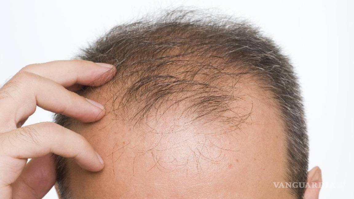 La mitad de los hombres pierden cabello por estrés y hormonas